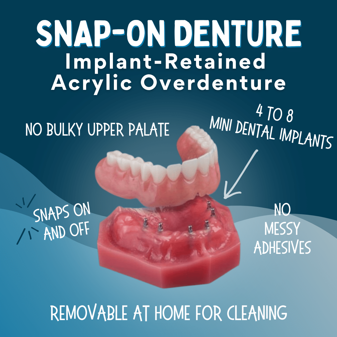 Snap-On Denture in Kaysville, UT - Utah Denture and Implant Center