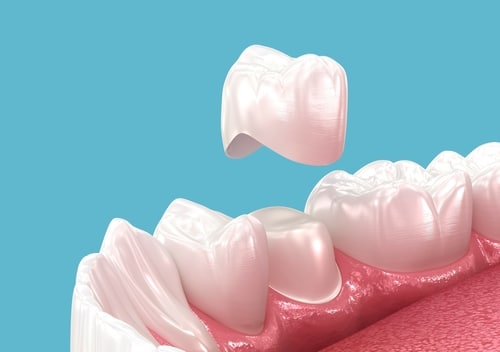 Dental Crown in Kaysville, UT | Dr. Ruedi Tillmann