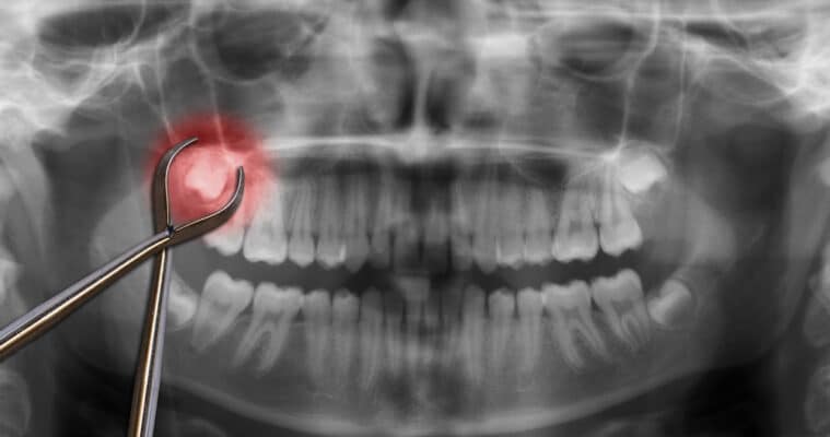 Dental Extraction in Kaysville, UT