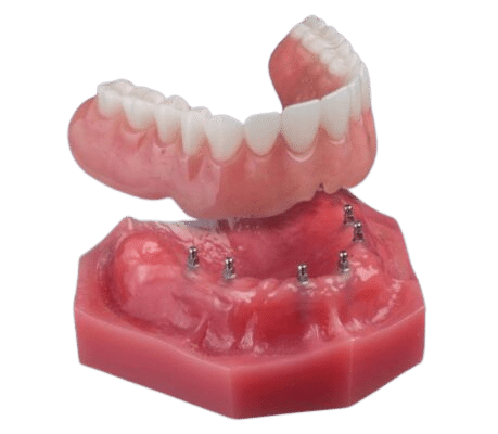 Dentures in Salt Lake City, UT | Dr. Ruedi Tillmann
