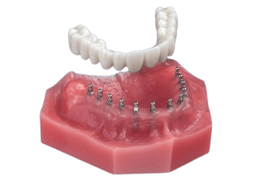 Implant Dentures in Kaysville, UT | Dr. Ruedi Tillmann