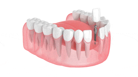 Same-Day Dental Implants in Salt Lake City, UT