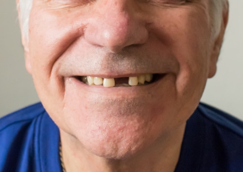 Missing Teeth in Kaysville, UT | Book a Free Implant Consultation