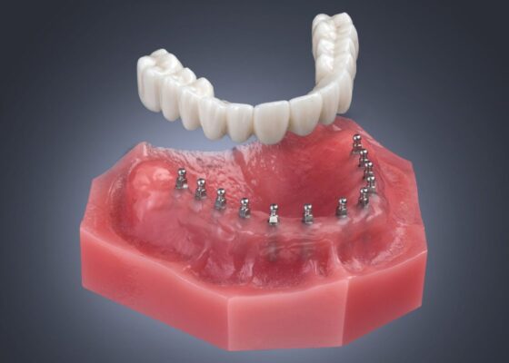 Permanent Dentures in Kaysville, UT | Mini Dental Implant Options