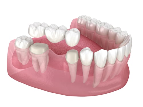 Tooth Replacement in Kaysville, UT | Book a Free Consultation
