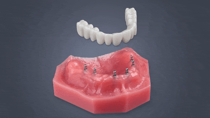All on 4 Alternatives in Kaysville, UT | Fix-on-Six | Free Consultation