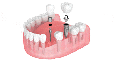 Ogden Implant Dentist | Mini Dental Implants in Kaysville, UT