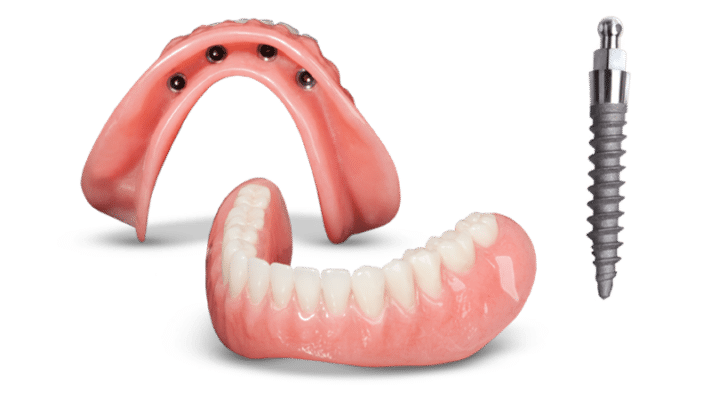 Denture Options in Kaysville, UT | Book an Implant Consultation