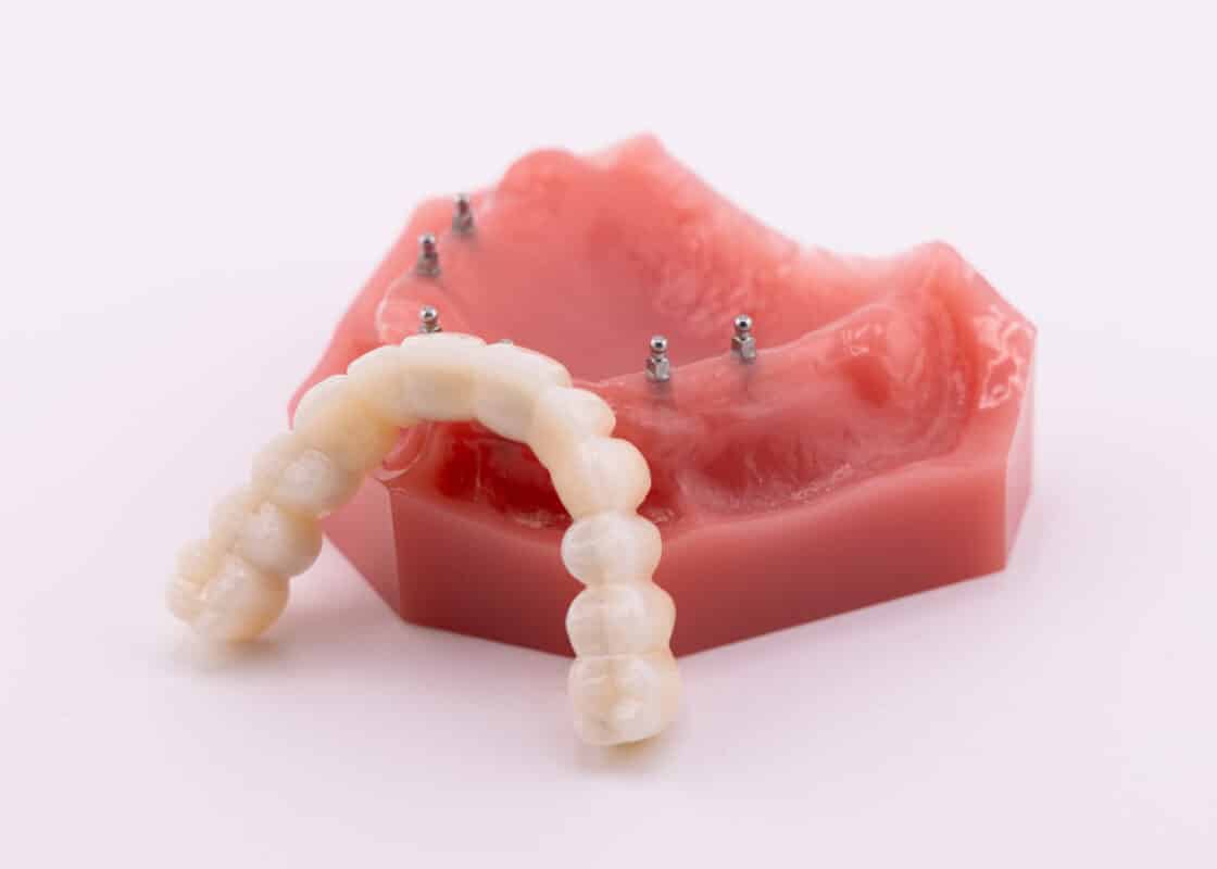 Full Arch Implants in Kaysville, UT | Book a Free Consultation