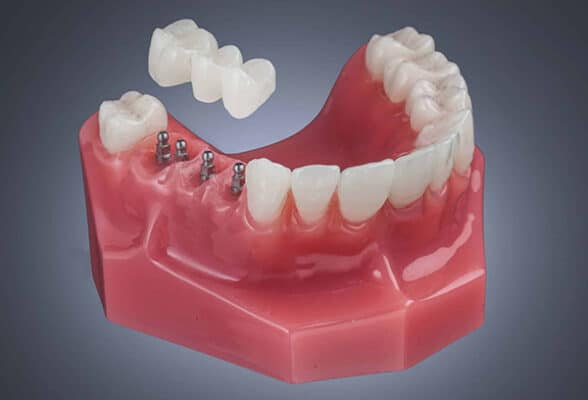 Implant Bridges in Kaysville, UT | Book a Free Implant Consultation