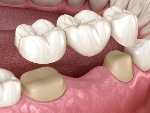 Implant Bridges in Kaysville, UT | Book a Free Implant Consultation