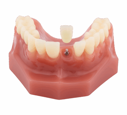 Mini Dental Implant in Kaysville, UT | Schedule a Free Consultation