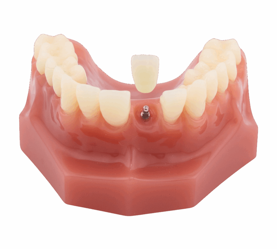 Mini Dental Implant in Kaysville, UT | Schedule a Free Consultation