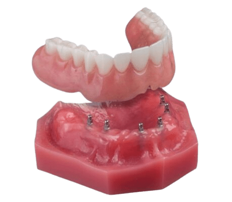 Full Dentures in Kaysville, UT | Secure Your Smile With Mini Implants