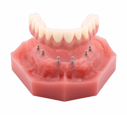 Denture Implants in Kaysville, UT | Book a Free Consultation