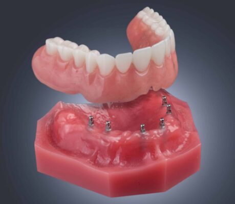 Mini Dentures in Kaysville, UT | Schedule a Free Consultation 😁