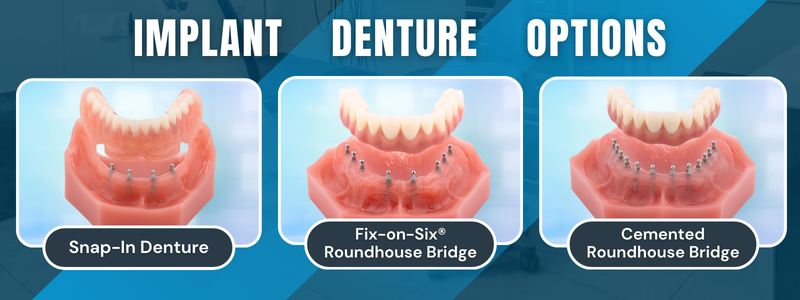 Mini Implant Dentures in Kaysville, UT | Upgrade Your Denture | Free Consultation