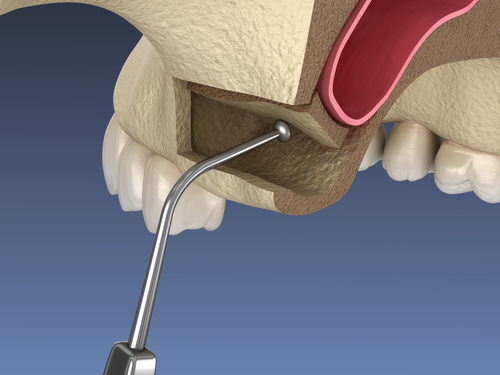 Sinus Lift in Kaysville, UT | Free Dental Implant Consultations